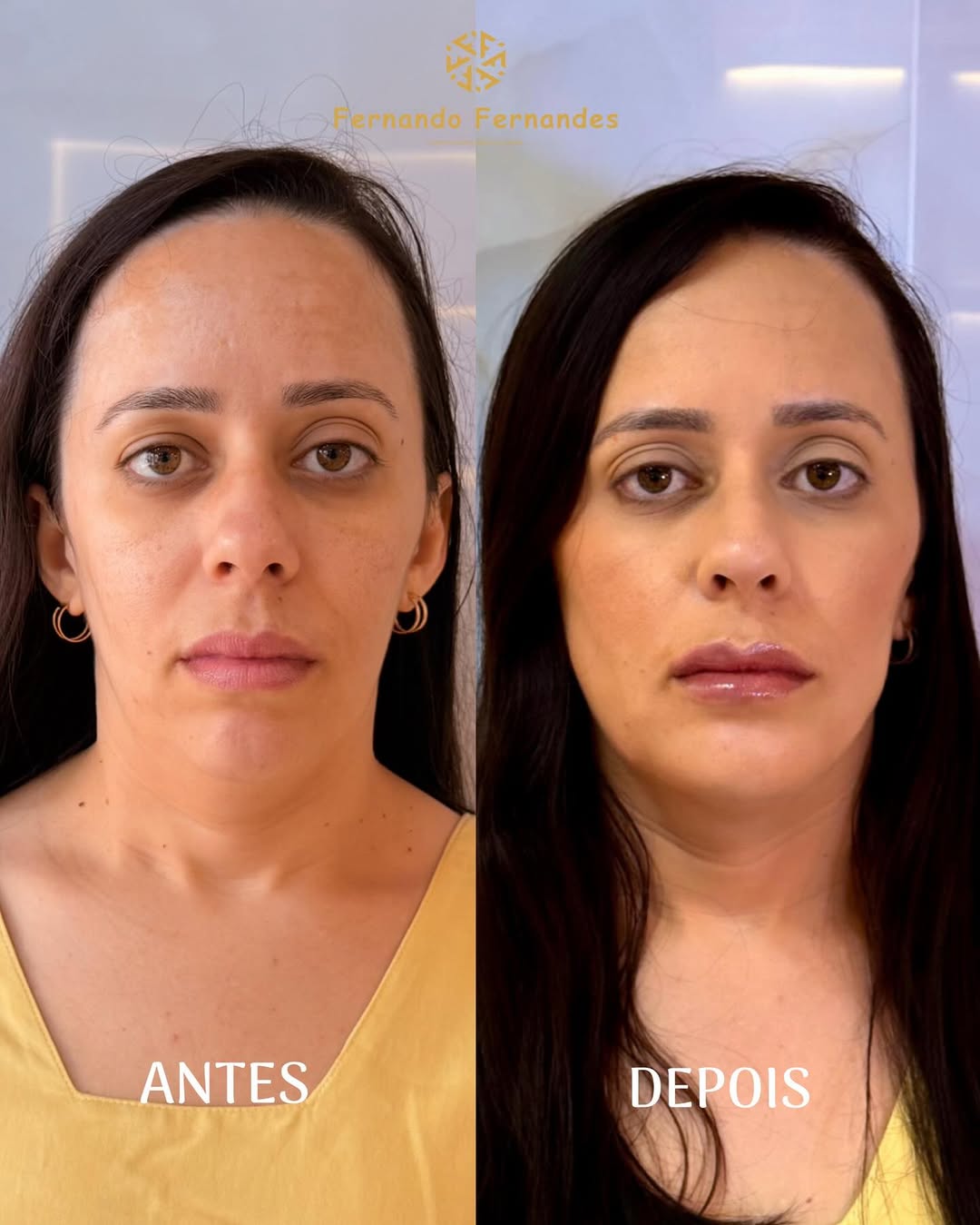 Resultado Harmonização Facial — Antes e Depois